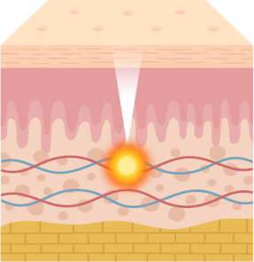 이노벨 전체 시술